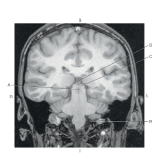 <strong>Questions 16 through 18 refer to the figure below of a coronal MR of the olive and medulla oblongata.   Which arrow points to the pineal gland?</strong> A) A B) B C) C D) D <div style=padding-top: 35px> 