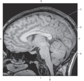 <strong>Questions 19 and 20 refer to the figure below of a midsagittal MR of the brain.   Which arrow points to the pons?</strong> A) A B) B C) C D) D <div style=padding-top: 35px> 