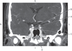 <strong>Questions 21 through 24 refer to the figure below.   Which arrow points to the sphenoid sinus?</strong> A) A B) B C) C D) D <div style=padding-top: 35px> 