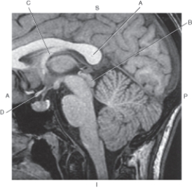 <strong>Questions 25 through 28 refer to the figure below.   Which arrow points to the optic chiasm?</strong> A) A B) B C) C D) D <div style=padding-top: 35px> 