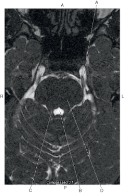 <strong>Questions 29 through 32 refer to the figure below.   Which arrow points to the trigeminal nerve?</strong> A) A B) B C) C D) D <div style=padding-top: 35px> 