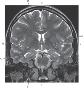 <strong>Questions 33 through 36 refer to the figure below of a coronal, T2-weighted MRI of the brain.   Which arrow points to the third ventricle?</strong> A) A B) B C) C D) D <div style=padding-top: 35px> 