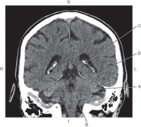 <strong>Questions 37 through 40 refer to the figure below of a coronal CT reformat of the brain.   Which arrow points to the cerebellum?</strong> A) A B) B C) C D) D <div style=padding-top: 35px> 