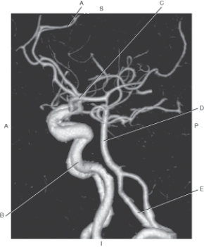 <strong>Questions 41 through 45 refer to the figure below of a lateral CTA of cerebral arteries.   Which arrow points to the middle cerebral artery?</strong> A) A B) B C) C D) D E) E <div style=padding-top: 35px> 