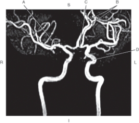 <strong>Questions 46 through 49 refer to the figure below of a coronal oblique MRA of cerebral arteries.   Which arrow points to the anterior cerebral artery?</strong> A) A B) B C) C D) D <div style=padding-top: 35px> 
