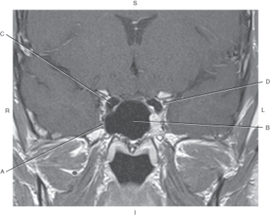 <strong>Questions 50 through 53 refer to the figure below of a coronal T1-weighted MRI of the cavernous sinus with contrast enhancement.   Which arrow points to the sphenoid sinus?</strong> A) A B) B C) C D) D <div style=padding-top: 35px> 