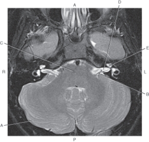 <strong>Questions 54 through 58 refer to the figure below of an axial T2-weighted MRI of the brain.   Which arrow points to the cochlea?</strong> A) A B) B C) C D) D E) E <div style=padding-top: 35px> 