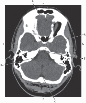 <strong>Questions 59 through 63 refer to the figure below of an axial CT of the brain.   Which arrow points to the cerebellopontine angle (CPA)cistern?</strong> A) A B) B C) C D) D E) E <div style=padding-top: 35px> 