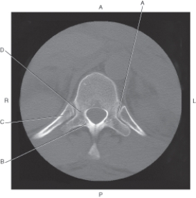 <strong>Questions 6 through 8 refer to the figure below of an axial CT of the thoracic vertebra. Which arrow points to the lamina?</strong> A) A B) B C) C D) D