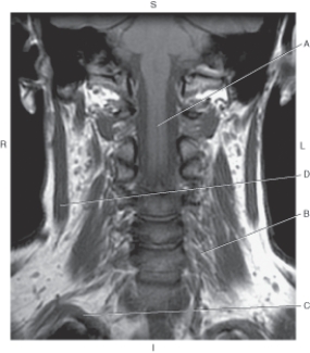 <strong>Questions 12 through 15 refer to the figure below. Which arrow points to the spinal cord?</strong> A) A B) B C) C D) D