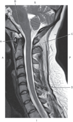 <strong>Questions 32 through 35 refer to the figure below of a midsagittal, T2-weighted MRI of the cervical spine with spinal ligaments. Which arrow points to the tectorial membrane?</strong> A) A B) B C) C D) D