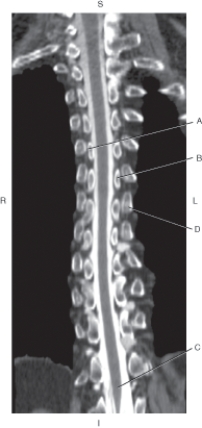 <strong>Questions 40 through 43 refer to the figure below of a coronal CT reformat of the thoracic spine, post myelogram. Which arrow points to the costotransverse joint?</strong> A) A B) B C) C D) D
