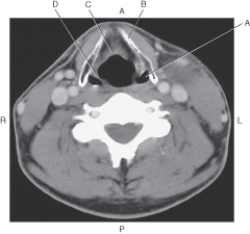 <strong>In the figure below of an axial CT of the neck with thyroid cartilage,which arrow points to the thyroid cartilage? </strong> A) A B) B C) C D) D