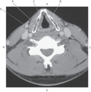 <strong>In the figure below of an axial CT of the larynx with vocal cords and arytenoid cartilages,which arrow points to the arytenoid cartilage? </strong> A) A B) B C) C D) D