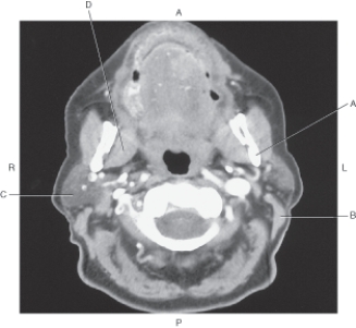 <strong>In the figure below of an axial CT of the neck,which arrow points to the parotid gland? </strong> A) A B) B C) C D) D