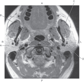 <strong>In the figure below of an axial MR of the neck,which arrow points to the medial pterygoid muscle? </strong> A) A B) B C) C D) D