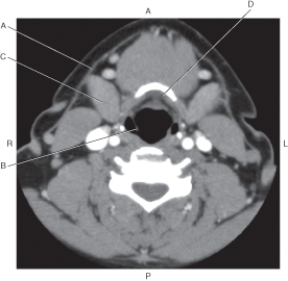 <strong>Questions 23 through 26 refer to the figure below of an axial CT of the neck. Which arrow points to the hyoid gland?</strong> A) A B) B C) C D) D