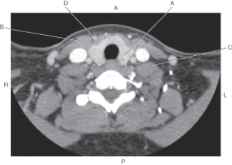 <strong>Questions 27 through 30 refer to the figure below of an axial CT of the neck. Which arrow points to the thyroid gland (left lobe)?</strong> A) A B) B C) C D) D