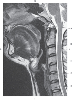 <strong>Questions 31 through 35 refer to the figure below of a midsagittal, T2-weighted MRI of pharyngeal divisions. Which arrow points to the cricoid cartilage?</strong> A) A B) B C) C D) D E) E