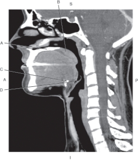 <strong>Questions 36 through 39 refer to the figure below of a sagittal CT reformat of the pharynx. Which arrow points to the hard palate?</strong> A) A B) B C) C D) D