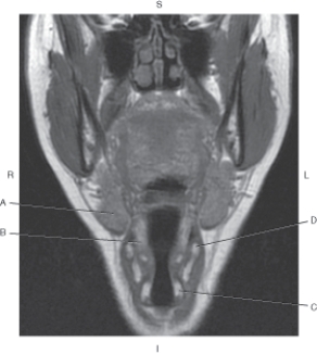 <strong>Questions 40 through 43 refer to the figure below of a coronal, T1-weighted MRI of the piriform sinuses. Which arrow points to the submandibular gland?</strong> A) A B) B C) C D) D