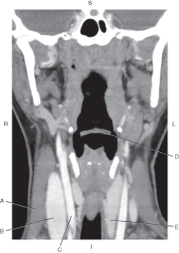 <strong>Questions 44 through 48 refer to the figure below of a coronal CT reformat of the neck. Which arrow points to the thyroid gland?</strong> A) A B) B C) C D) D E) E