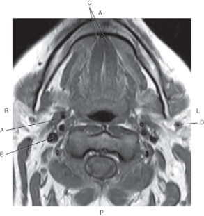 <strong>Questions 49 through 52 refer to the figure below of an axial, T1-weighted MRI of the sublingual glands. Which arrow points to the internal jugular vein?</strong> A) A B) B C) C D) D