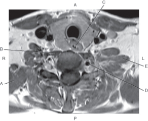 <strong>Questions 53 through 57 refer to the figure below of an axial, T1-weighted MRI of the neck. Which arrow points to the esophagus?</strong> A) A B) B C) C D) D E) E
