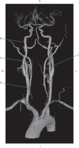 <strong>Questions 58 through 61 refer to the figure below of a CTA of intracranial and extracranial arteries. Which arrow points to the common carotid artery?</strong> A) A B) B C) C D) D