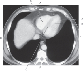 <strong>In the figure below of an axial CT of heart with pericardium,which arrow points to the epicardial fat? </strong> A) A B) B C) C D) D