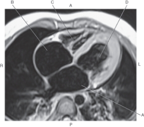 <strong>In the figure below of an axial,T1-weighted MRI with four-chamber view of heart,which arrow points to the right atrium? </strong> A) A B) B C) C D) D