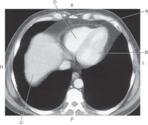 <strong>In the figure below of an axial CT of heart with pericardium,which arrow points to the right ventricle? </strong> A) A B) B C) C D) D
