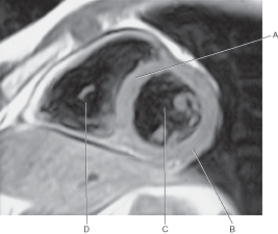 <strong>In the figure below of a short-axis MR of the heart,which arrow points to the left ventricle? </strong> A) A B) B C) C D) D