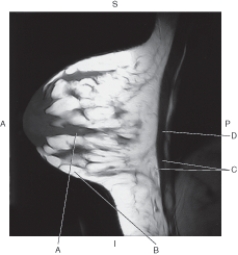 <strong>Questions 22 through 25 refer to the figure below of a 3D CT of the aortic arch. In the figure below an a sagittal MR of the breast,which arrow points to the glandular tissue? </strong> A) A B) B C) C D) D