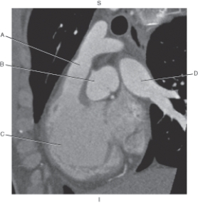 <strong>Questions 27 through 30 refer to the figure below of an RVOT CT. Which arrow points to the root of the aorta?</strong> A) A B) B C) C D) D