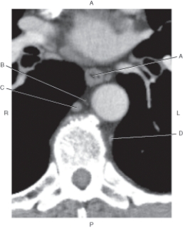 <strong>Questions 31 through 34 refer to the figure below. Which arrow points to the esophagus?</strong> A) A B) B C) C D) D