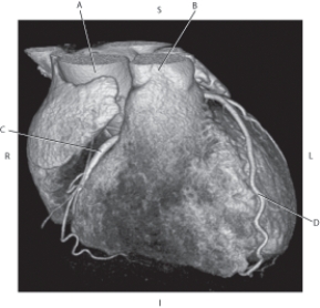 <strong>Questions 35 through 38 refer to the figure below. Which arrow points to the right coronary artery?</strong> A) A B) B C) C D) D