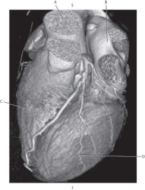 <strong>Questions 39 through 42 refer to the figure below. Which arrow points to the ascending aorta?</strong> A) A B) B C) C D) D