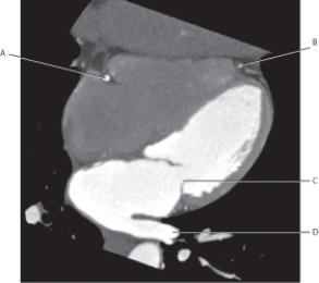 <strong>Questions 43 through 46 refer to the figure below of a horizontal long axis CT. Which arrow points to the right coronary artery?</strong> A) A B) B C) C D) D