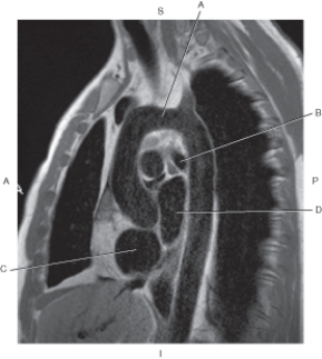 <strong>Questions 47 through 50 refer to the figure below of a sagittal, T1-weighted MRI of the heart with left atrium. Which arrow points to the aortic arch?</strong> A) A B) B C) C D) D