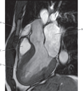 <strong>Questions 51 through 54 refer to the figure below of an LVOT MRI. Which arrow points to the pulmonary trunk?</strong> A) A B) B C) C D) D