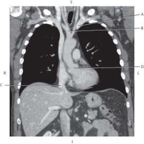 <strong>Questions 55 through 58 refer to the figure below of a coronal CT reformat of the serratus anterior muscle. Which arrow points to the root of the aorta?</strong> A) A B) B C) C D) D