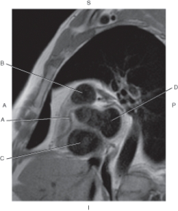 <strong>Questions 59 through 62 refer to the figure below of a sagittal, T1-weighted MRI of the heart with pulmonary trunk. Which arrow points to the right coronary artery?</strong> A) A B) B C) C D) D