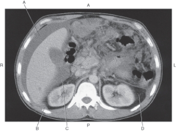 <strong>In the figure below of an axial CT of the abdomen,which arrow points to Morison's pouch? </strong> A) A B) B C) C D) D