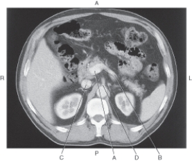 <strong>In the figure below of an axial CT of the abdomen,which arrow points to the splenic vein? </strong> A) A B) B C) C D) D