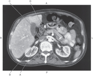 <strong>In the figure below of an axial CT of the pancreas and pancreatic duct,which arrow points to the common bile duct? </strong> A) A B) B C) C D) D