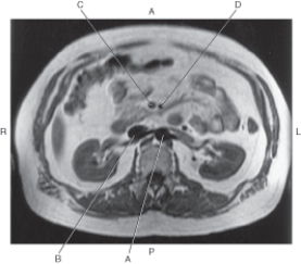 <strong>In the figure below of an axial MR of the abdomen,which arrow points to the superior mesenteric artery? </strong> A) A B) B C) C D) D