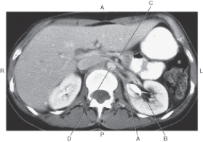 <strong>In the figure below of an axial CT of the abdomen,which arrow points to the left renal vein? </strong> A) A B) B C) C D) D