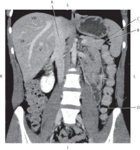 <strong>Questions 24 through 27 refer to the figure below of a coronal CT reformat of liver segments. Which arrow points to the left psoas muscle?</strong> A) A B) B C) C D) D