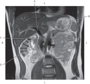<strong>Questions 28 through 31 refer to the figure below of a coronal, T2-weighted MRI of the abdomen and CBD. Which arrow points to the common bile duct?</strong> A) A B) B C) C D) D